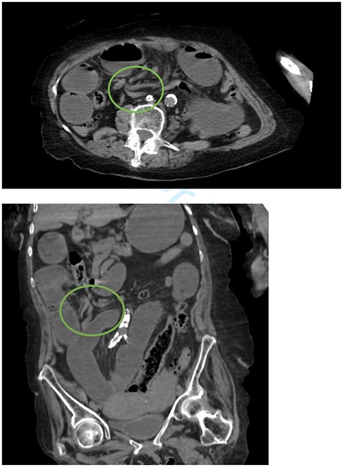 Whirlpool sign indicated by a circle representing a twisting of the mesentery around the superior mesenteric artery.