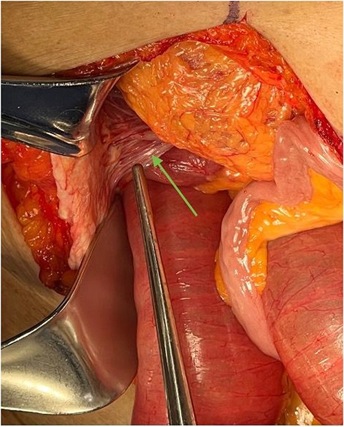 Ladd’s bands are noted in the right upper quadrant during exploratory laparotomy, indicated by an arrow. In this case, these bands adhere the cecum to the abdominal wall.