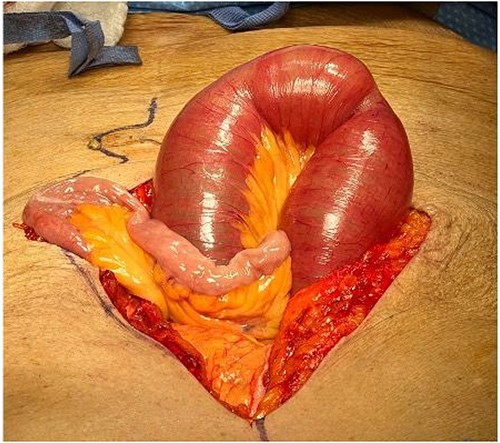 Dilated loops of small bowel proximal to obstruction and collapsed bowel distal to the obstruction.