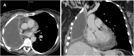 CT (A) axial and (B) coronal views showing fluid filled pneumonectomy space with nodularity and thickened right pleura measuring 6 mm anteriorly.