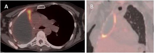 PET (A) axial and (B) coronal views showing increased FDG uptake (max SUV 9.5) along the anteromedial and inferior aspects of the right lung pleura.