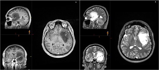 Initial MRI demonstrating a non-contrast enhancing left frontotemporal insular lesion. (A) T1-weighted post contrast; (B) T2-weighted.