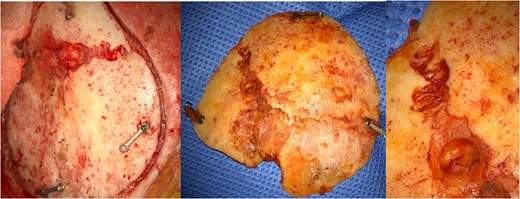 Bone flap with coronal suture diastases.
