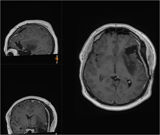 Postoperative (second surgery) MRI demonstrating residual tumour at the posterior margin of the insula.