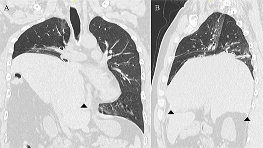 Chest computed tomography showing that the liver had prolapsed into the thoracic cavity. (A) Coronal view. (B) Sagittal view. The arrowhead indicates the edge of the torn diaphragm, including the torn staple line.