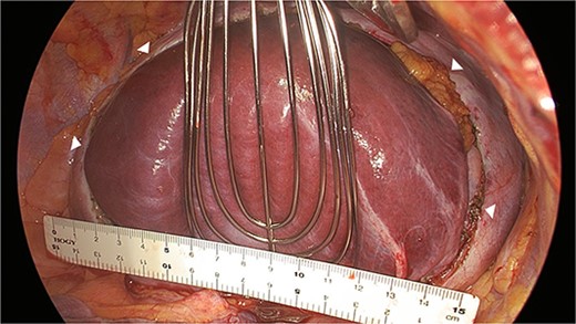 Surgical view showing the large diaphragmatic defect of 15 cm (arrowhead).