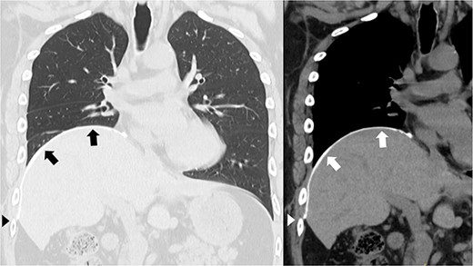 Postoperative chest computed tomography showing the reconstructed diaphragm using a second polytetrafluoroethylene (PTFE) patch above the original placement, overlaying the diaphragmatic defect that had been closed by the first PTFE patch (arrow). The second PTFE patch was fixed to the lower ribs (arrowhead).