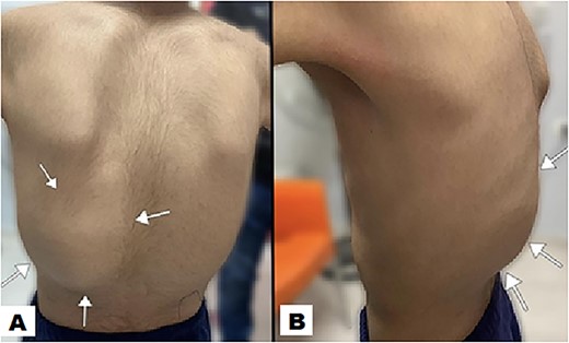 The posterior view illustrates a swelling (indicated by arrow) in the left lower posterior chest region, characterized by the absence of redness in the overlying skin (A). A lateral view offers a perspective of the swelling on the left posterior chest wall, measuring ~13 × 15 × 2 cm (B).