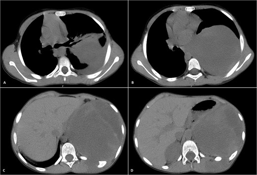 Selected axial CT images with mediastinal windowing showing multiple cuts of the patient’s chest. A huge relatively well-defined heterogeneous mass lesion is noted occupying the left lower hemi-thorax causing left lung volume loss and significant rightward mediastinal shift. No definite invasion of the adjacent ribs, however, remodeling of the lower aspect of the left posterior tenth rib is noted with the widening of the left tenth intercostal space and involvement of the left erector spinae muscles by the previously mentioned mass.