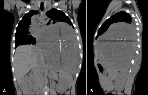 Selected coronal (A) and sagittal (B) cuts showing the size and the extension of the previously mentioned mass.