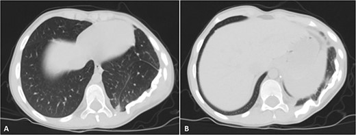 Selected axial cuts of the patient’s chest–lung window. The previously mentioned left posterior chest wall mass is no longer seen with post-operative changes noted.