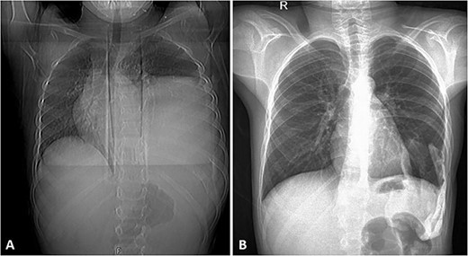 (A) Frontal chest radiograph of the same patient showing a left-sided opacity involving the left middle and lower lung zones and silhouetting the diaphragm and the left cardiac border in keeping with the known huge left posterior chest wall tumor. Widening of the posterior aspect of the left 10th intercostal space is noted. (B) Frontal chest radiograph taken during follow-up visits ~2 years following the surgical resection of the tumor, it shows re-expansion of the left lung with no residual or recurrent masses.