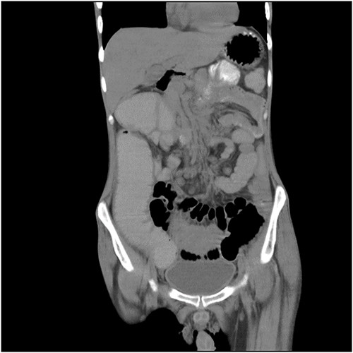 CT coronal picture of the abdomen and pelvis, illustrating dilated loops and intussusception.