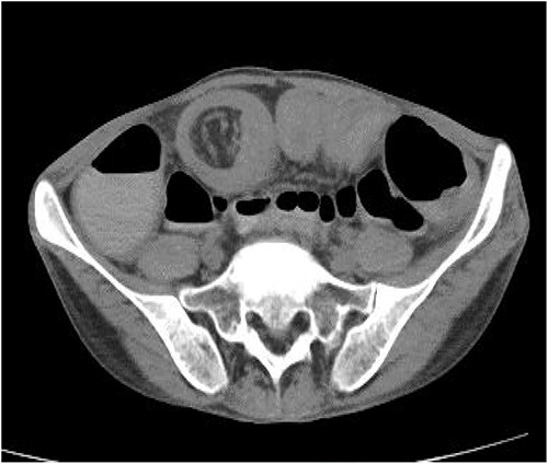 CT axial image showing a spherical mass referred as ‘target-like lesion/ donut-like lesion’, indicative of intussusception.