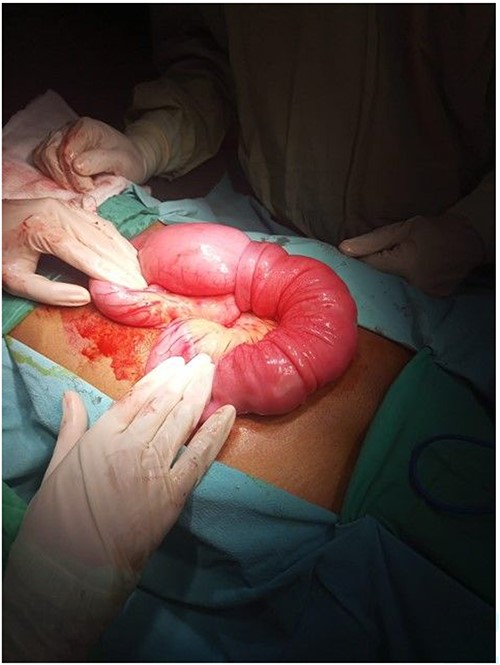 Telescoping segment of ileum.