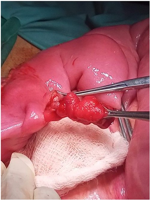 Pedunculated hamartamatous poly in small intestine.