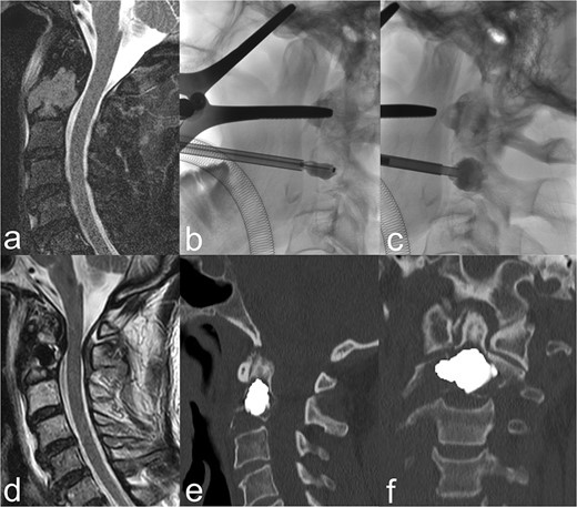 (a) The sagittal heavily T2-weighted fat-suppressed MRI imaging shows myeloma-related osseous destruction/pathological fracture of the corpus vertebrae axis. (b) BKP via a transoral approach. (c) After removal of the balloon catheter, the cavity created is filled with PMMA cement. (d) Centrally located cement plug in the sagittal T2-weighted MRI slice. (e) and (f) The sagittal and coronal reformed CT slices show a cement plug located centrally in the lesion. Cement leakage can be ruled out.