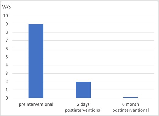 Pain development of the osseous destruction of the corpus vertebrae axis in the course after BKP.