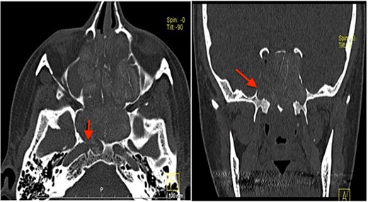 CT scan, left imaging is an axial view, without contrast, showing complete opacification of all paranasal sinuses with heterogeneous density inside the sinuses; with erosion in the distal part of the right petrous carotid canal abutting the right sphenoid sinus (arrow); right image is a coronal view, showing extensive polyposis with bony erosion in the bony boundaries of the sphenoid sinuses.