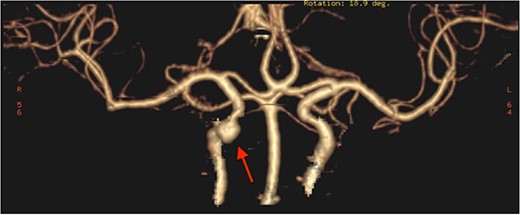 CT angiography, showing pseudoaneurysmal dilatation at the petrous segment of the right ICA.