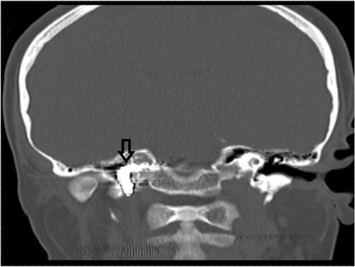 CT scan, showing complete occlusion of the right ICA at the petrous and cervical parts (arrow).