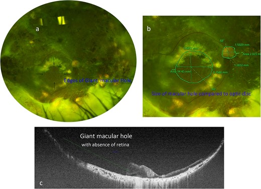 (a) Optos fundus photograph of the right eye showing a large refractory macular hole temporal to the optic nerve. (b) Zoomed-in Optos photograph of the posterior pole demonstrating the measurements of the large macular hole as well as the measurements of the optic nerve for comparison. (c) Swept-source OCT image taken across the diameter of the macular hole, demonstrating its extensive length (green line).