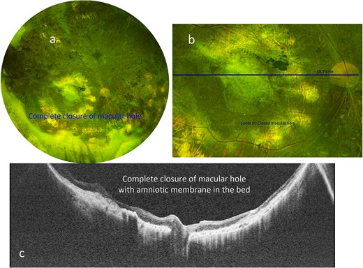 (a) Optos color fundus photograph of the right eye after amniotic membrane placement, with tissue remaining in place above the location of the previously demonstrated macular hole. (b) Zoomed-in Optos color photograph of the posterior pole demonstrating the graft in place. The green line indicates the location of the swept-source OCT in c. (c) Swept-source OCT shows the hole has been closed with amniotic membrane graft in place, and flat without subretinal fluid.