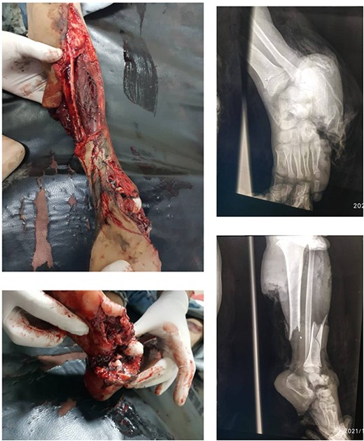 Displays the fractured image alongside the X-ray images taken prior to the intervention.