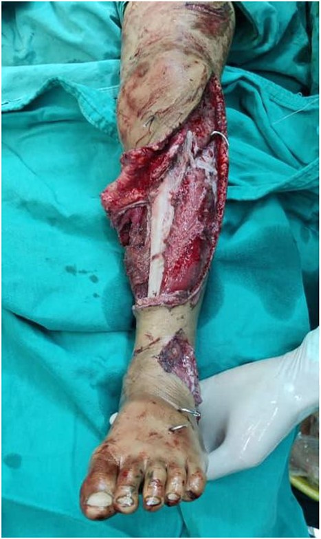 Shows the leg following the placement of the K-wire and prior to suturing the skin flap.