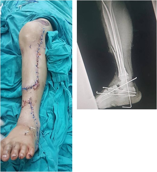 Displays the leg after suturing the skin flap, along with the X-ray image following the installation of the K-wires.