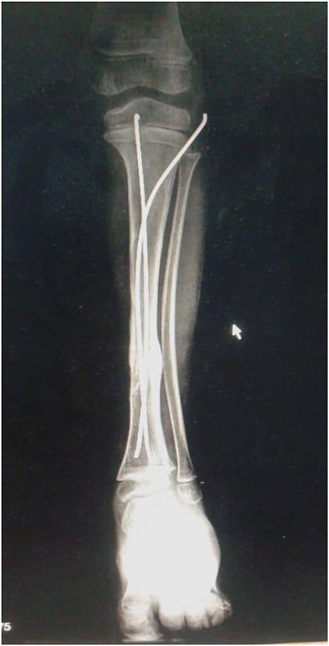 Shows the leg 2 months post-surgery, following the removal of wires.