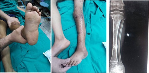 Shows the leg after 8 months post-surgery, indicating successful completion of the recovery process.