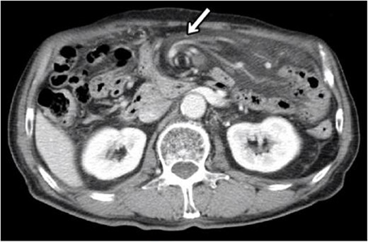 CT at initial diagnosis. CT revealed a whirl sign of the SMA and branches wrapped with the adjacent mesentery and small bowel loops, which are characteristic of SBV (allow).