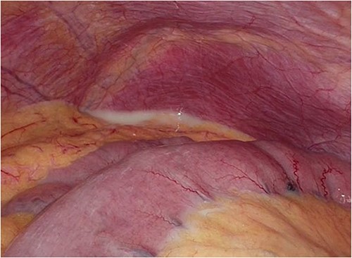 Intraoperative photograph showing CA in the abdominal cavity.