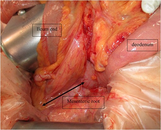 Intraoperative photograph showing that the entire small bowel was twisted 360° counterclockwise.