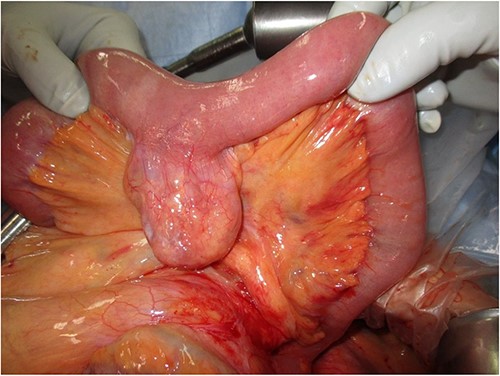 Intraoperative photograph showing a small palm-sized diverticulum on the mesenteric side of the upper jejunum.