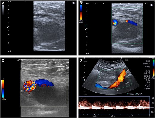 Duplex sonography shows a mass compressing the femoral vein from dorsally.