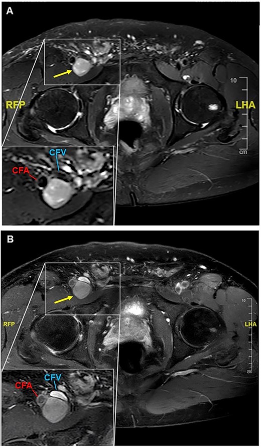 T1-weighted MR-images of the right groin are presented pre- (A) and post-application of contrast medium (B). (A) A tumor with a diameter of 26 × 24 × 54 mm is seen dorsal to the common femoral vein and artery. In the left lower corner, a magnification of the area of interest is shown. CFV = common femoral vein; CFA = common femoral artery. (B) Addition of contrast displays the compression of the common femoral vein, but no flow impairment is seen. In the left lower corner, a magnification of the tumor is presented.