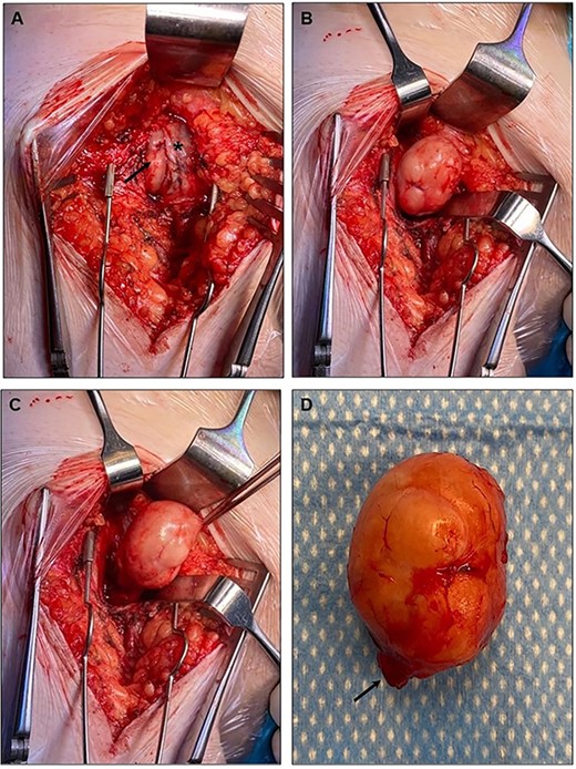 The intraoperative findings are presented. (A) The asterisk indicates the common femoral vein, whereas the arrow indicates the tumor compressing the vein from dorsally. (B, C) Intraoperative preparation steps. (D) Excised tumor. The arrow indicates its vascular supply deriving from the caudal border from the lesion.