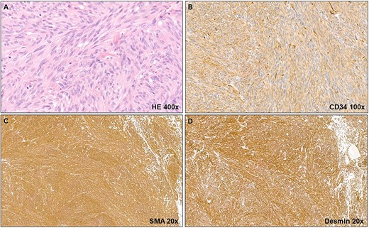(A) The histopathological examination shows spindle cells (smooth muscle cells) with no mitotic figures or nuclear atypia. Moreover, no necrosis is seen. (B) Immunohistochemical staining reveals a low CD34 expression. (C, D) Further immunohistochemical staining shows positivity for SMA and desmin.