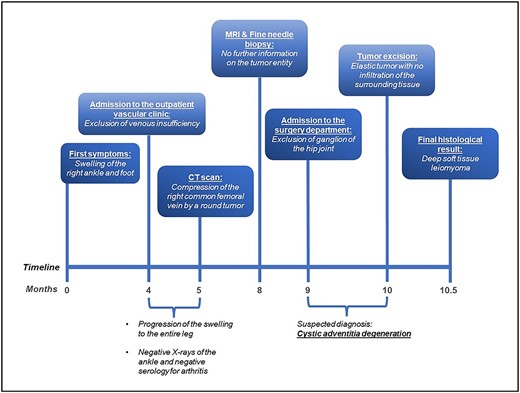 The timeline from first appearance of symptoms to the final diagnosis is represented. Four months after appearance of the first symptoms, swelling of the right ankle and foot, the patient was admitted to the vascular outpatient clinic to exclude venous insufficiency. At this time, duplex sonography of the venous system was unremarkable. After excluding arthritis of the right ankle serologically and radiologically and because of a progression of the edema to the entire leg, a CT scan was performed to exclude pelvic vein thrombosis. A tumor compressing the right common femoral vein was discovered. Significant compression of the venous flow were confirmed by duplex sonography. After 8 months, an MRI and a fine needle biopsy were performed, which provided no further information about the entity of the tumor. After 9 months, the patient was admitted to the surgical department and a month later he was scheduled for tumor excision. The tumor was successfully excised in toto and did not show any signs of infiltration. Histological analysis required external validation due to the rare histological configuration. Two weeks after surgery, deep soft tissue leiomyoma was confirmed. In summary, it took almost one year from initial clinical presentation to the final diagnosis.