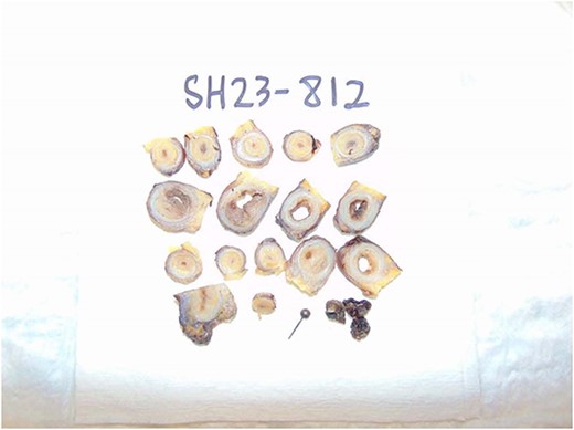 Gross pathology specimen showing transverse sections of appendix.