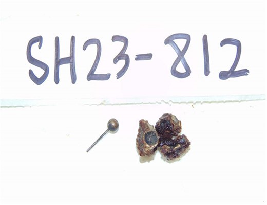 Gross pathology specimen showing fecalith and foreign body from lumen of appendix.