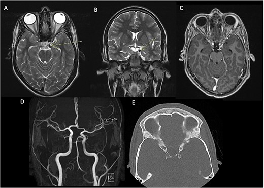 Pre-surgical MRI (A–C) showing the presence of a lesion with low signal intensity on T2-weighted sequences (A, B) of 0.7 × 0.6 cm adjacent to anterior clinoid process and tents, concerning the oculomotor left cistern, with peripheral enhancement in post-contrast sequences (C) contacting the left third cranial nerve. No evidence of aneurysms in angiogram MRI (D). Head CT scan (E) with a calcified exophytic lesion concerning the left anterior clinoid.