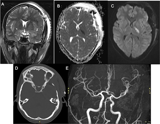 Postoperative MRI with left third cranial nerve decompression in T2-weighted sequence (A) and a high DWI signal and low ADC signal in the posterior limb of left internal capsule (B, C) with no occlusion in angiogram MRI demonstrating ischemic event (E) Head CT Scan (D) without compressive lesion.
