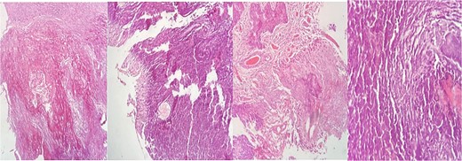 Hematoxylin–eosin (HE) staining with extensive calcified tissue is recognized. There are areas of myxoid tissue, focal piloid proliferation, arachnoid cellularity, and mononuclear inflammatory cells.