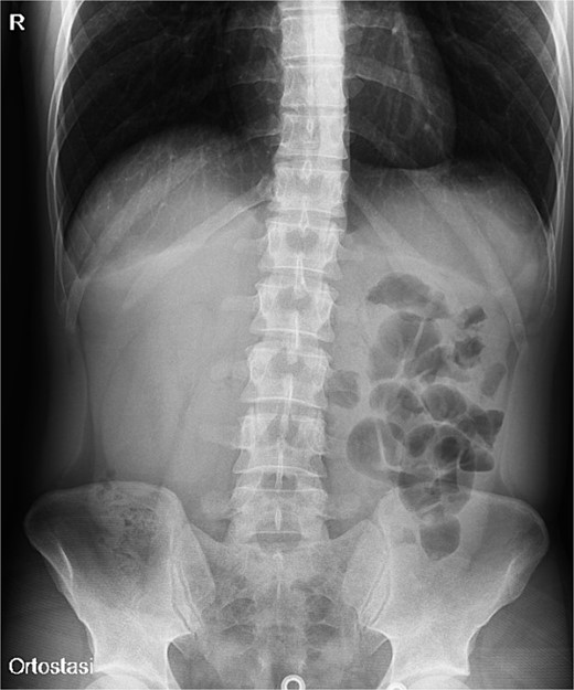 Plain abdomen X-ray showing limited visibility of the colon on the right side with small bowel loops’ distension on the left regions, without free air.