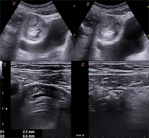 Abdomen ultrasound image displaying visceral distension with a cockade appearance consistent with an inflammatory condition of the cecum and the ileocecal site, showing wall thickening of 6 up to 10 mm and free fluid near the cecum.