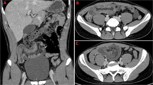 A and B: Coronal and axial sections of contrast-enhanced CT scan confirming wall thickening of the last ileal loop and the cecum up to 20 mm. C: CT imaging performed the following day, displaying increased wall thickening up to 24 mm with the last ileal loop appearing twisted around its mesentery.