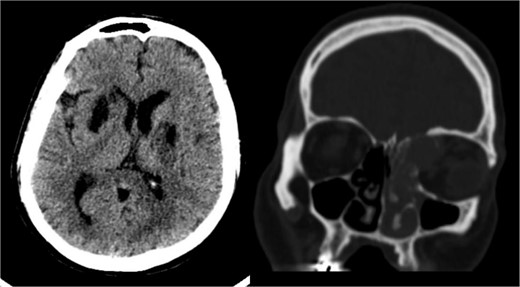 High-resolution CT scan with an axial cut (left side) showing a bilateral basal ganglia hypodense area suggestive of chronic ischemia and a nearby hypodense area at the left basal ganglia indicative of subacute ischemia (A). A coronal cut (right side) shows an iso-dense expansible soft tissue lesion with internal foci of calcifications centered in the anterior aspect of the left ethmoid sinus with protrusion to the left orbital conus pushing the medial rectus muscle laterally with complete obliteration of the left frontal sinus.